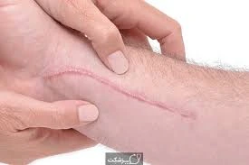 اسکار زخم و راههای درمان آن