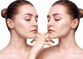 تزریق فیلر زاویه فک